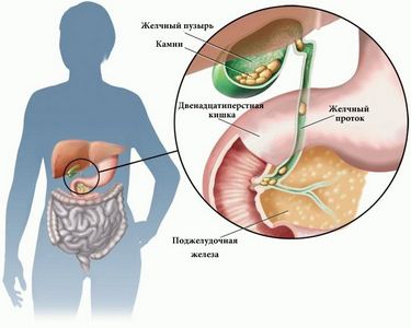 Панкреатит - основные симптомы хронической и острой формы панкреатит