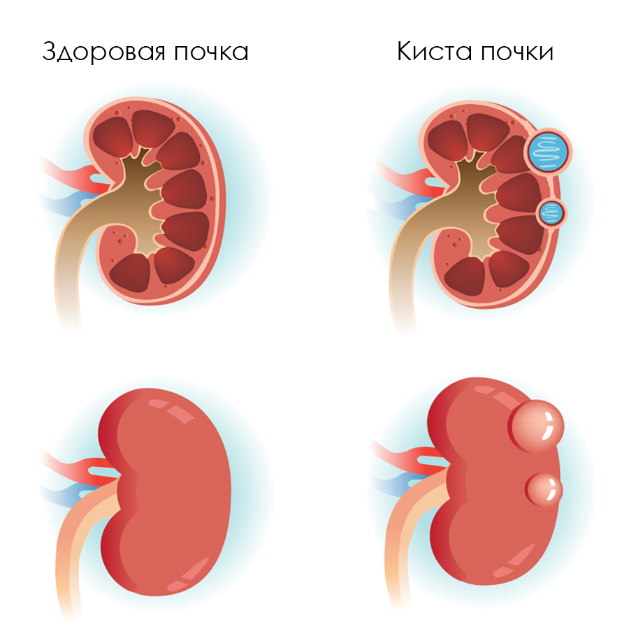 Как выглядит киста фото