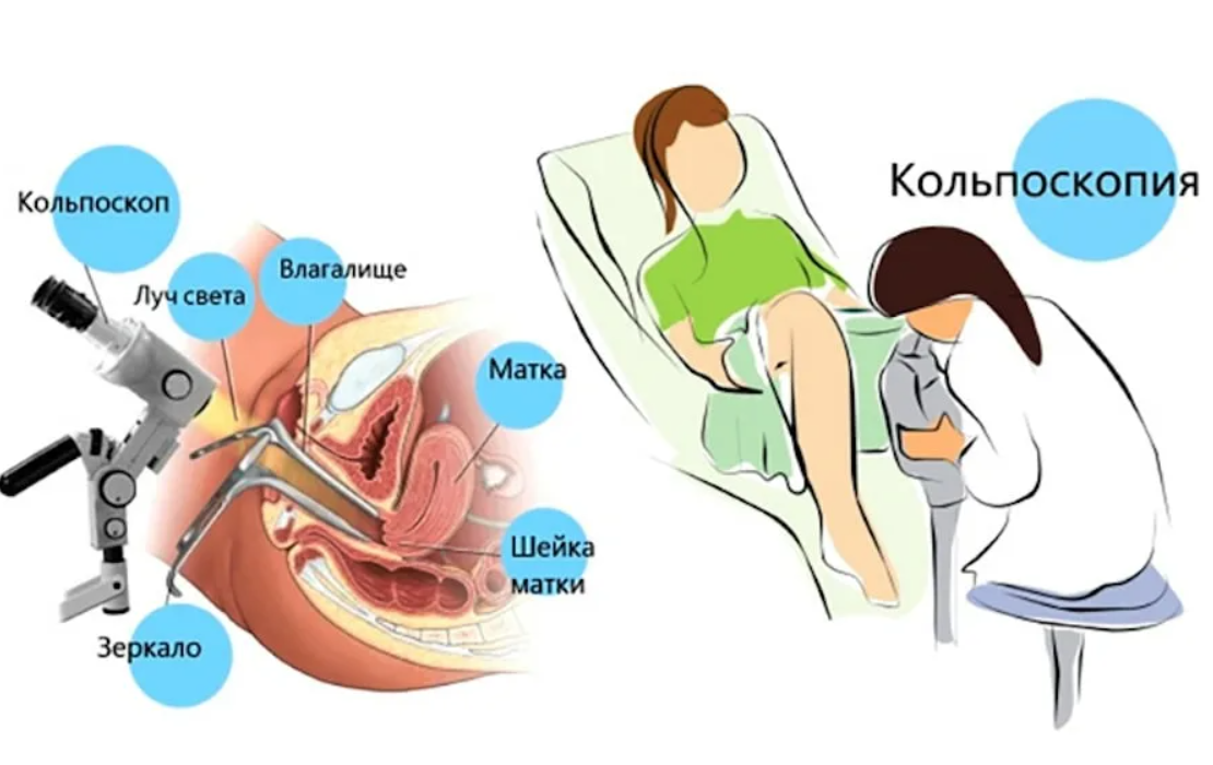 Кольпоскопия шейки матки схема